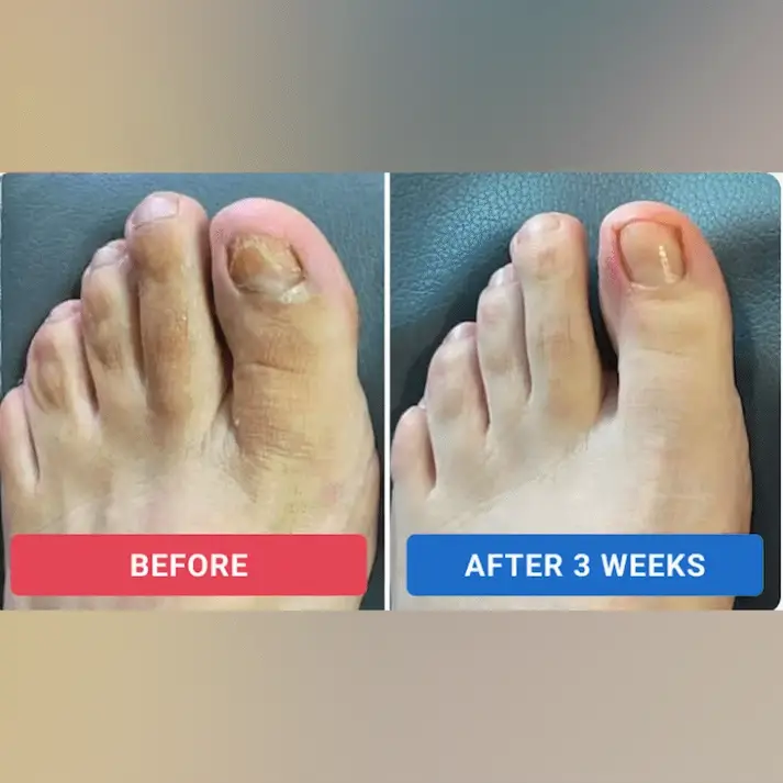 Nail Repair Patches - Image 4