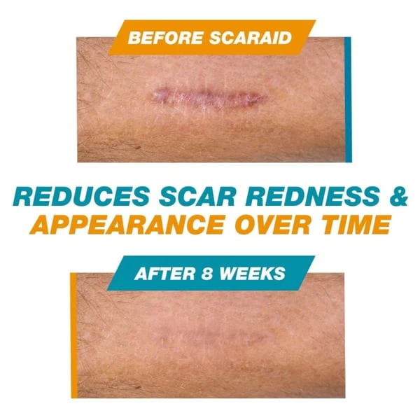 SCAR SOLUTIONS - Silicone Scar Stick - For Face and Body - Image 12